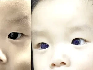 Mata Cokelat Bayi di Thailand Berubah Biru Setelah Pengobatan COVID-19