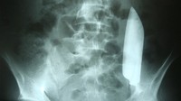 Seorang pria 22 tahun di Nepal pergi ke rumah sakit karena keluhan sakit perut. Ternyata, ada pisau berukuran 5 inci atau sekitar 15 cm menyangkut di dalam perutnya. (Foto: Cureus Journal of Medical Science)
