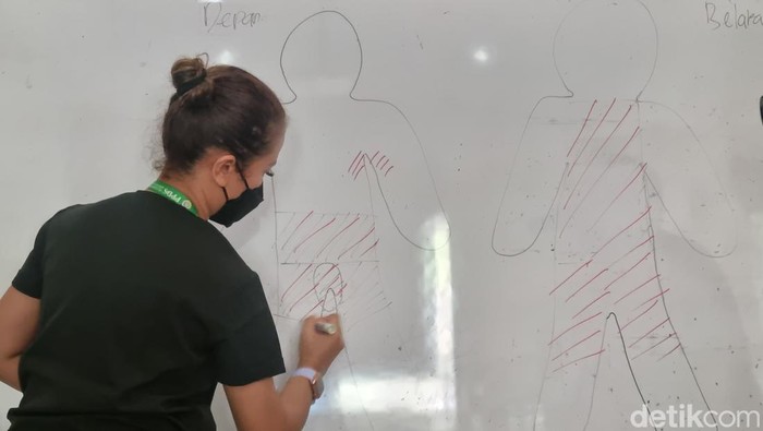 Dokter spesialis bedah plastik RSU dr Soetomo yang menangani RPQ, dr Ira Handriani SpBP-RE (K) (tengah).

Tim medis di RSU dr Soetomo menggambarkan anatomi tubuh RPQ yang mengalami luka bakar.
