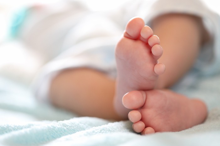 Ilustrasi Bayi Achondroplasia