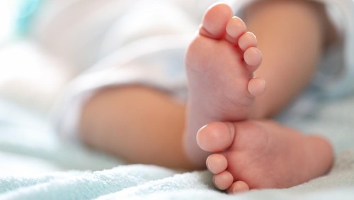 Ilustrasi Bayi Achondroplasia