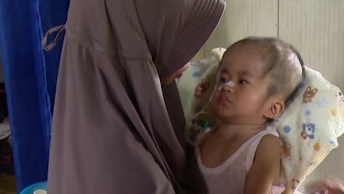Noor Rizky, bocah pengidap hidrosefalus