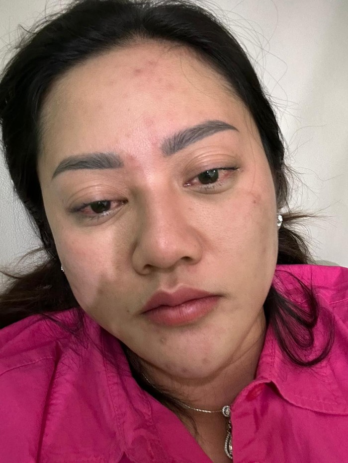 Kondisi Heni ketika mengalami reaksi alergi
