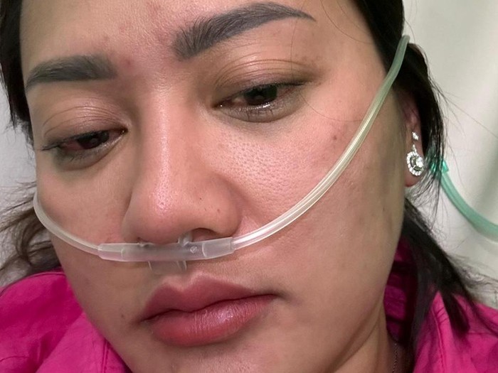 Kondisi Heni ketika mengalami reaksi alergi