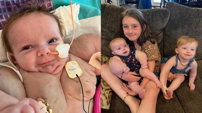 Viral Bayi Lahir Berotot bak Baby Hulk, Ternyata Idap Penyakit Langka