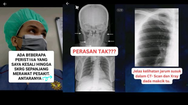 Cerita dokter Malaysia yang melihat susuk di dalam tubuh pasiennya