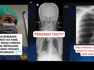 Cerita Dokter Malaysia Tangani Pasien dengan Susuk di Wajah hingga Dada