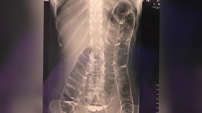 Viral Foto Rontgen Usus Naik ke Atas Dinarasikan Tak BAB 1 Bulan, Ini Faktanya