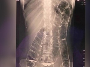 Fakta-fakta Foto Usus Pasien Naik ke Dada, Disebut gegara Sembelit Parah