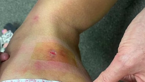 Turis digigit tomcat