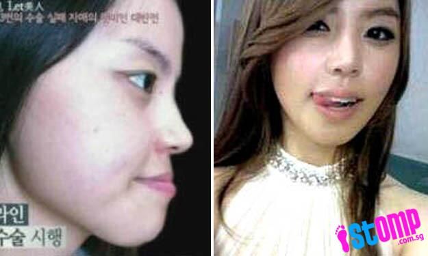 Kisah Wanita Operasi Plastik