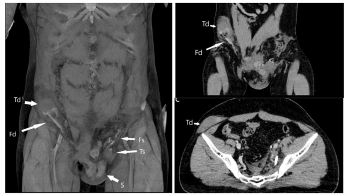 Kondisi Terakhir Pria yang Testisnya Pindah ke Perut usai Alami Kecelakaan Tragis