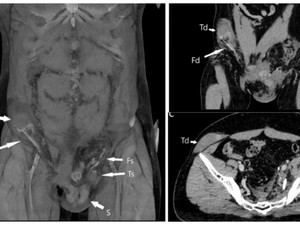Kasus Langka! Testis Pria Ini Masuk ke Perut gegara Kecelakaan Tragis
