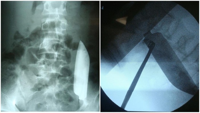 Keluhkan Sakit Perut, Ternyata Ada Pisau 15 Cm Nyangkut di Perut Pria Ini