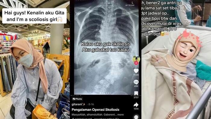 Tidak Semua Pasien Skoliosis Harus Operasi, Ini Ketentuannya