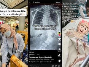 Tidak Semua Pasien Skoliosis Harus Operasi, Ini Ketentuannya