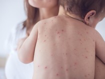 Video Pencegahan Cacar Air Pada Anak Kelainan Imunitas