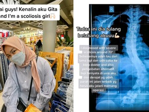 Wanita Bandung Idap Skoliosis Sejak Umur 15, Tinggi Badan Naik usai Operasi