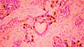 Juara ketiga diraih Malgorzata Lisowska. Menampilkan gambar sel kanker payudara. Foto: Nikon Small World Photomicrography