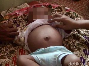 Tumor 2 Kg Diangkat dari Bayi Laki-laki yang Disebut Hamil di Sumbar