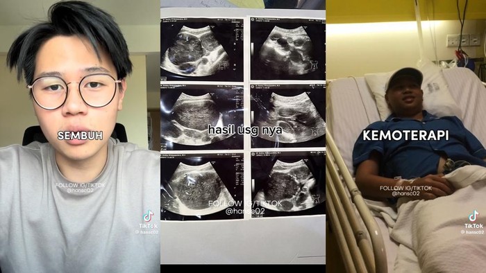 Viral Pria Umur 21 Kena Kanker Getah Bening, Gejala Awalnya Gampang Capek