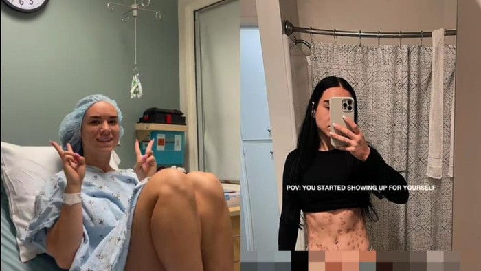 Tubuh Wanita Ini Digerogoti Luka Bernanah usai Suntik Bakar Lemak, Ini Penyebabnya