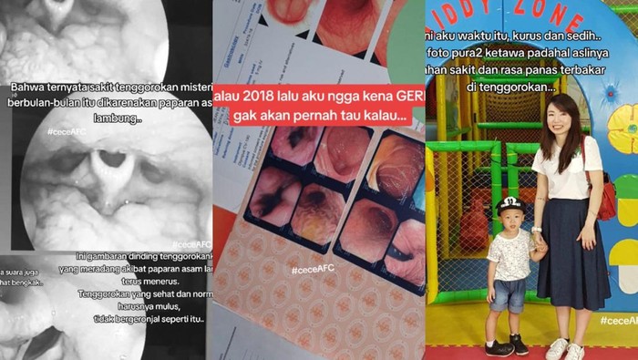 Kisah Wanita Surabaya Idap GERD, Alami Gejala Sakit Tenggorokan Tak Kunjung Sembuh