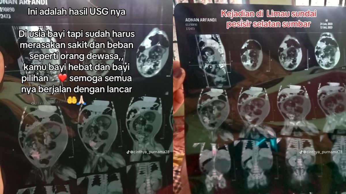Viral Bayi 5 Bulan 'Hamil' Diduga Fetus in Fetu, Kondisi Apa Itu?