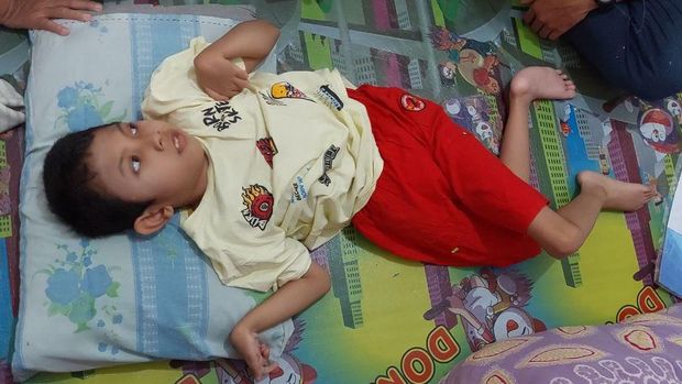 Alvino, bocah penderita Cerebral Palsy