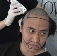 Kevin Aprilio jadi salah satu artis yang melakukan transplantasi rambut untuk daerah kepala dan janggut. Prosedur yang dilakukan di Turki ini membuat penampilan rambut Kevin Aprilio semakin tebal. Foto: Dok. Instagram