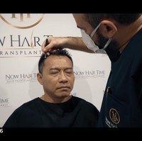 Kebotakan yang dialami Anang Hermansyah membuat dirinya memutuskan untuk melakukan transplantasi rambut. Keputusan cangkok rambut di Turki itu pun diinisiasi oleh sang istri, Ashanty. Foto: Dok. Instagram