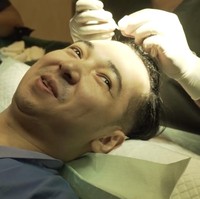 Garis rambut Edho Zell semakin lama semakin mundur. Tak mau terus merasa tak percaya diri, ia pun memilih untuk melakukan transplantasi rambut. Foto: Dok. Instagram