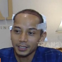 Fauzi Baadila mengalami kebotakan beberapa tahun terakhir, karena ketidakstabilan hormon. Merasa tak percaya diri, ia pun menjalani transplantasi rambut. Foto: Dok. Instagram