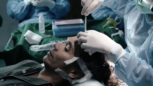 Penyanyi Kaka Slank juga memilih untuk menjalani transplantasi rambut karena garis rambut yang semakin mundur. Ia pun menjalani prosedur tersebut di klinik di Jakarta pada 2022 lalu. Foto: Dok. Instagram