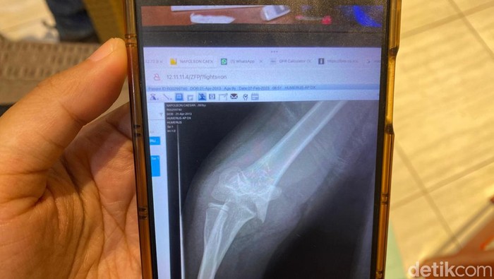 Ayah korban saat menunjukkan hasil rontgen patah tulang