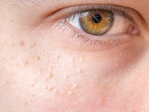 Cara Menghempas Milia di Wajah