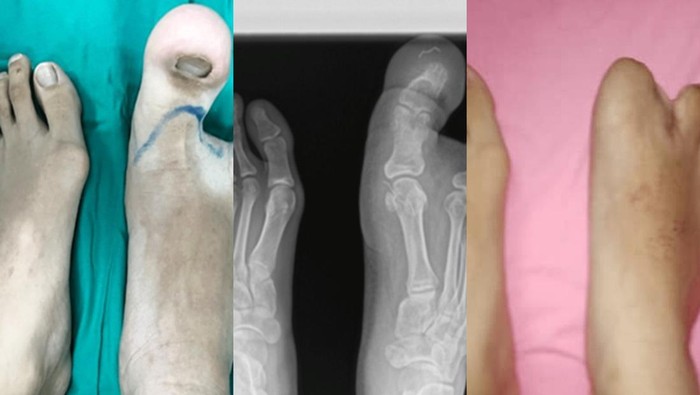 jempol kaki membesar imbas macrodystrophia lipomatosa