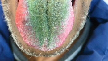 Kasus Langka Lidah Berbulu Hijau Foto: Reddit via Boredpanda