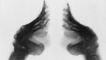 X-Ray Seorang Wanita China Yang Menjalani Pengikatan Kaki Foto: Reddit via Boredpanda