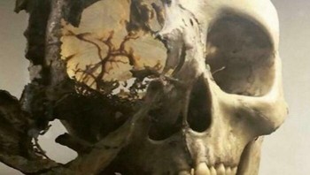 Akibat Kanker Tulang Foto: Reddit via Boredpanda