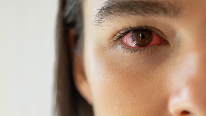 Red bloodshot eye.