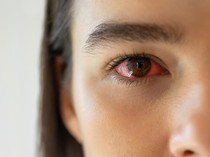 Viral Bocah SD di Palembang Alami Mata Lebam dan Merah