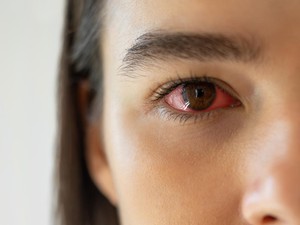 Mata Belekan Bisa Sembuh Berapa Hari? Ini Penyebab dan Cara Mengobatinya