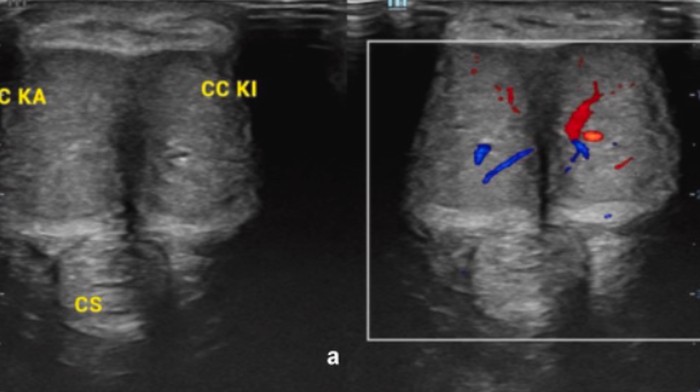 Kisah Pria Ereksi Seminggu Ternyata gegara Kanker, Berujung Diamputasi