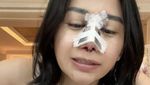Farida Nurhan Omay Brunch di Hotel Mewah dengan Kondisi Hidung Diperban