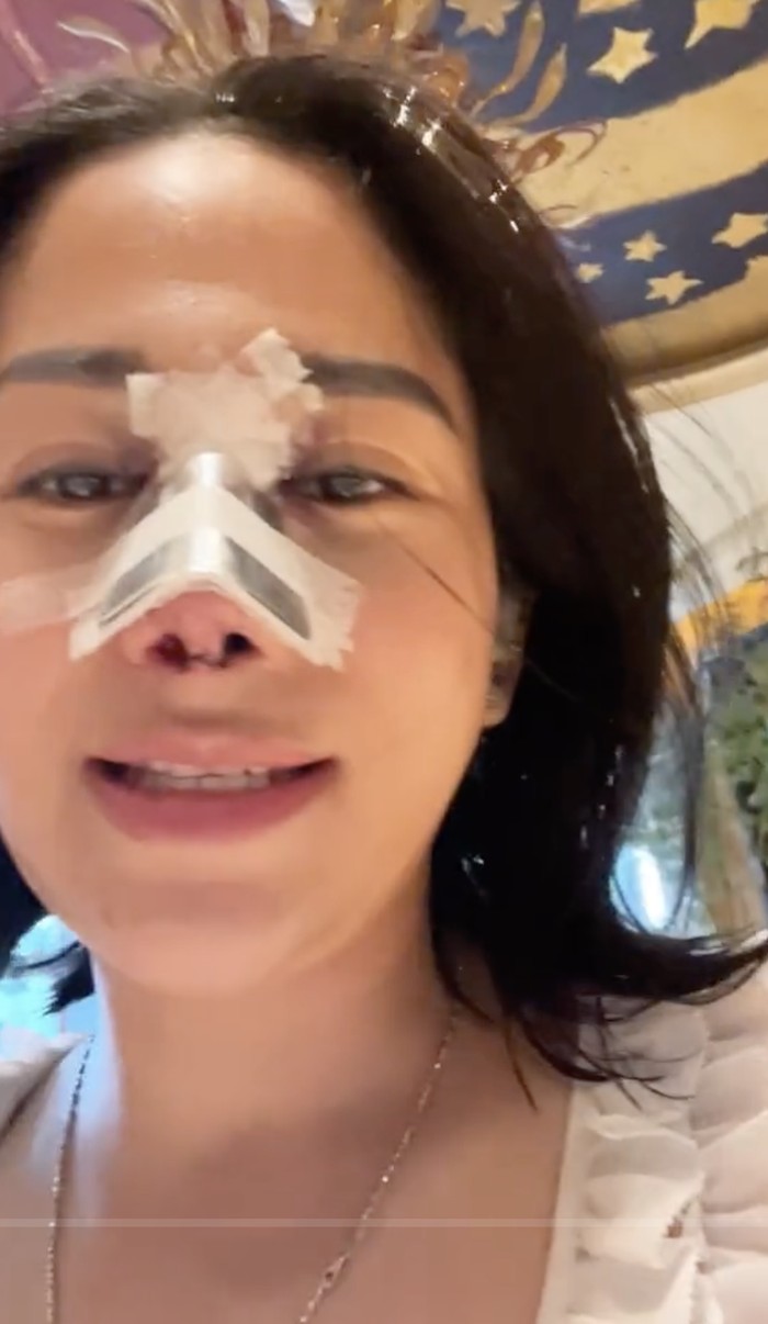 Farida Nurhan 'Omay' Brunch di Hotel Mewah dengan Kondisi Hidung Diperban