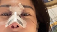 Di awal video, Omay mengajak penontonnya untuk ikut dirinya brunch di restoran Orient 8 yang ada di Hotel Mulia, Senayan. Kondisi hidungnya diperban dengan bekas jahitan yang terlihat. Foto: TikTok farida.nurhan