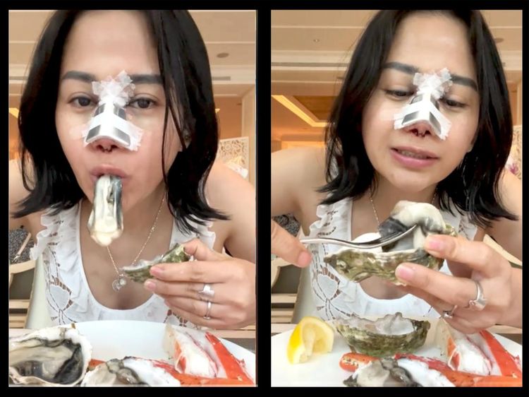 Farida Nurhan Omay Brunch di Hotel Mewah dengan Kondisi Hidung Diperban