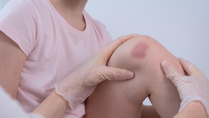 9 Penyebab Memar Tanpa Sebab dan Cara Mengatasinya yang Bisa Dilakukan di Rumah