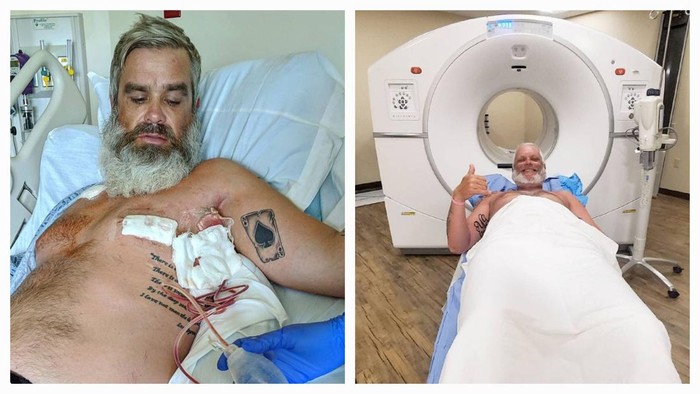 Cerita Pria Kena Kanker Payudara Stadium 4, Sempat Mengira Lelaki Tak Bisa Kena